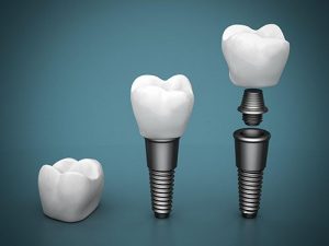 dental implants yeronga