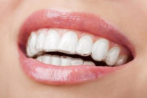 invisalign yeronga