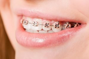 Orthodontics Yeronga