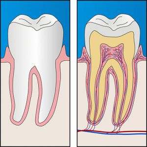 Root Canal Treatment Yeronga