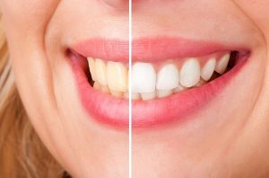 tooth whitening Yeronga