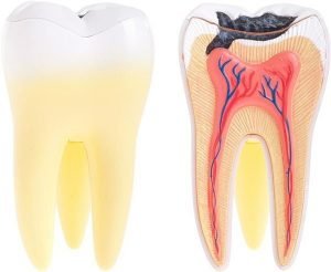 Tooth Decay Yeronga