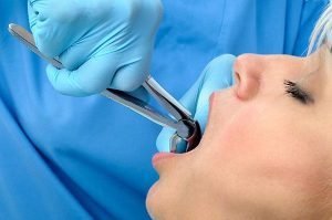 Tooth Extraction Yeronga