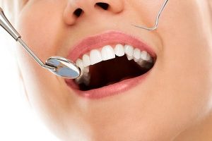 Tooth Fillings | Dentist Yeronga