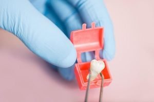 Wisdom Tooth Extraction Yeronga