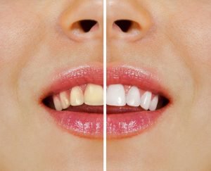 Ultimate Teeth Whitening Guide in Yeronga