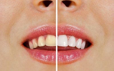 Ultimate Teeth Whitening Guide in Yeronga