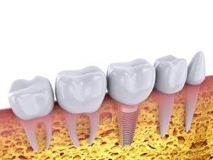 Ria Family Dental Tips Should I Get Dental Implants If I Have A Missing Tooth