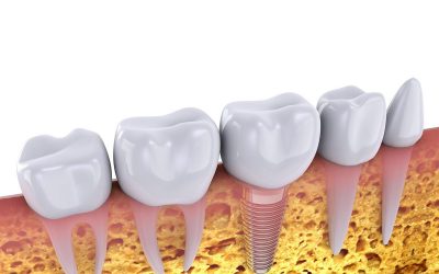 Ria Family Dental Tips: Should I Get Dental Implants If I Have A Missing Tooth?