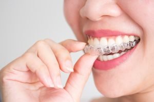 Does Invisalign Work Dentist Yeronga