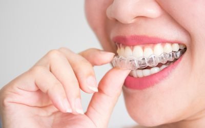Dental Guide: Does Invisalign Work?