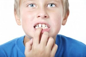 The Best Dental Solution to Fix Gaps in Teeth Yeronga