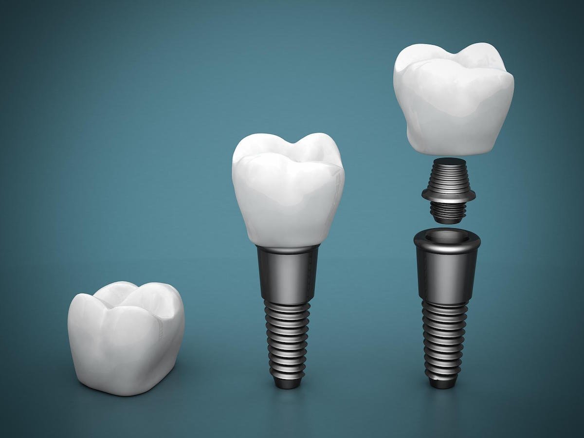 The Ultimate Guide to Dental Implants in Yeronga - Ria Family Dental