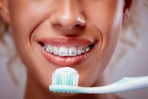 Yeronga Dentist Tips How can I keep my teeth clean when wearing braces