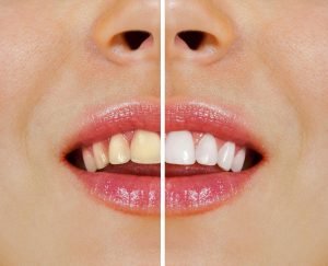 Over-the-Counter Whitening vs Whitening at Ria Family Dental Yeronga