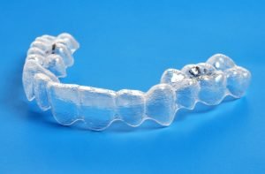 occlusal splints yeronga