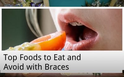 Top Foods to Eat and Avoid with Braces from Ria Family Dental