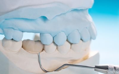 How Long Will Dental Crowns Last? Answers from Ria Family Dental