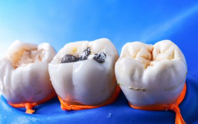 How to Pick the Best Type of Dental Fillings in Yeronga