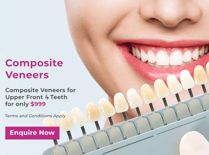 composite veneers for upper front promo banner