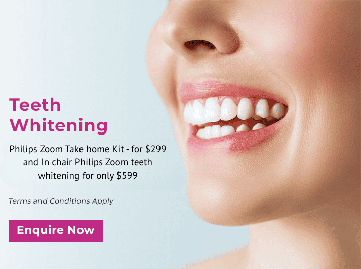 Teeth whitening offer featuring a smiling person in Yeronga