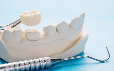 Dental Crown Benefits and Risks