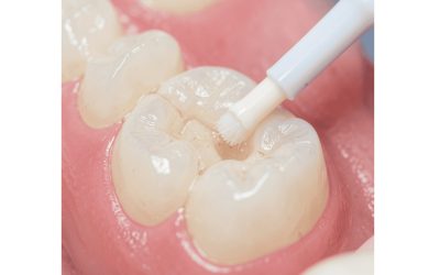 Dental Fillings: Types, Cost and What to Expect