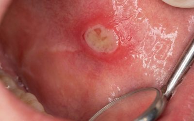 Mouth Ulcers: Causes, Treatment and When to See Your Dentist