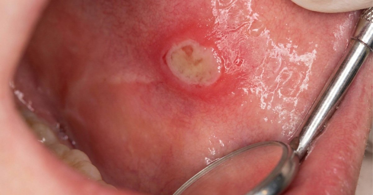 Close-up of a mouth ulcer on the inner cheek showing white centre and red border in Yeronga