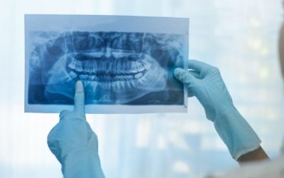 Impacted Wisdom Teeth: Do They Need to Come Out?