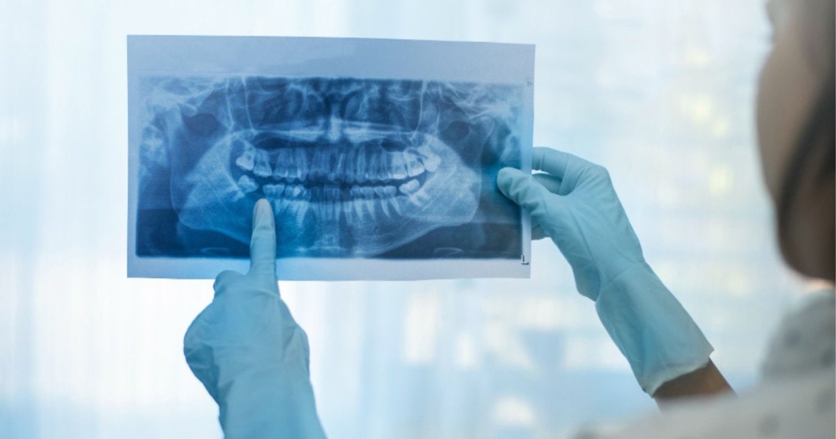 panoramic dental Xray being reviewed for wisdom teeth assessment in Yeronga